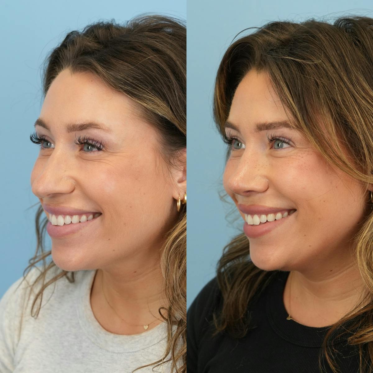 Rhinoplasty Before & After Gallery - Patient 425751 - Image 6