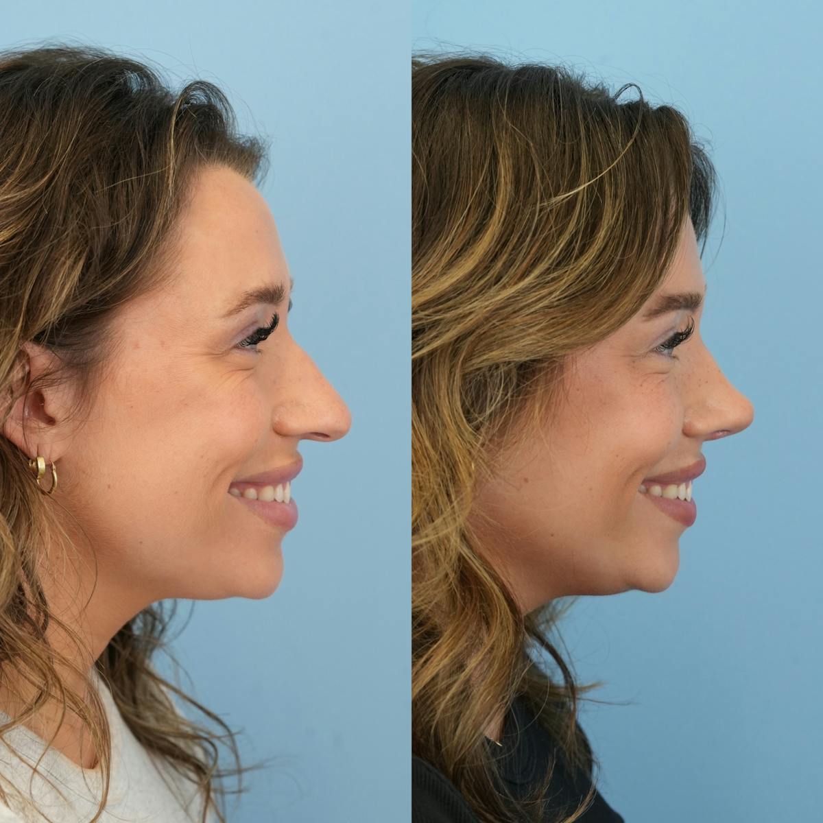 Rhinoplasty Before & After Gallery - Patient 425751 - Image 2