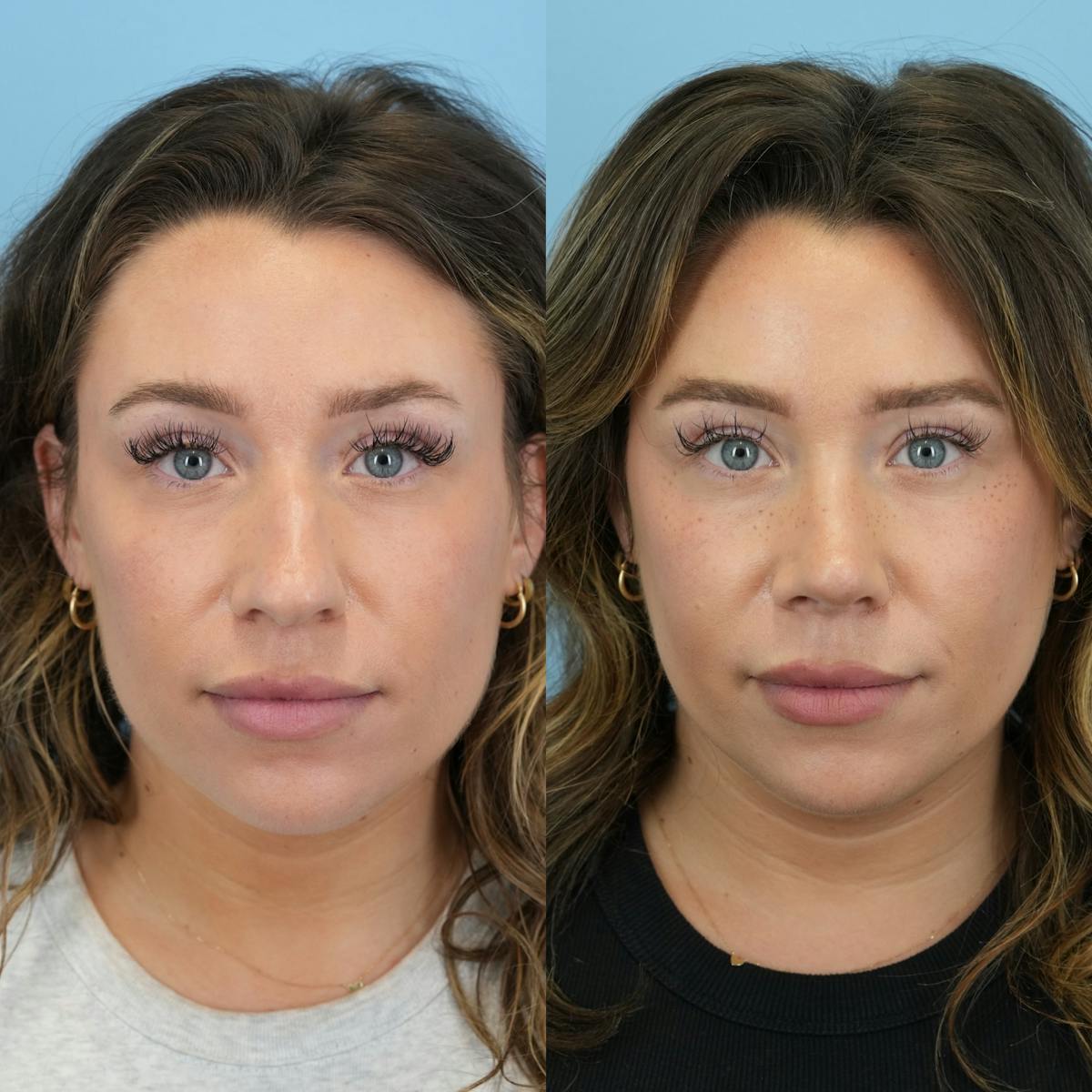 Rhinoplasty Before & After Gallery - Patient 425751 - Image 5