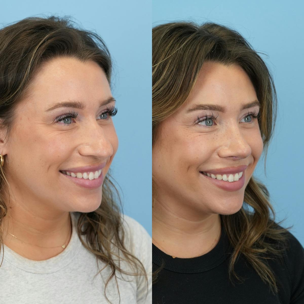 Rhinoplasty Before & After Gallery - Patient 425751 - Image 4