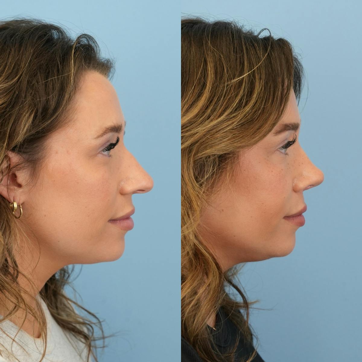 Rhinoplasty Before & After Gallery - Patient 425751 - Image 1