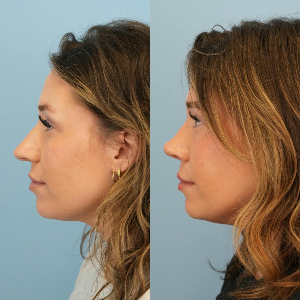 Rhinoplasty Before & After Gallery - Patient 425751 - Image 9
