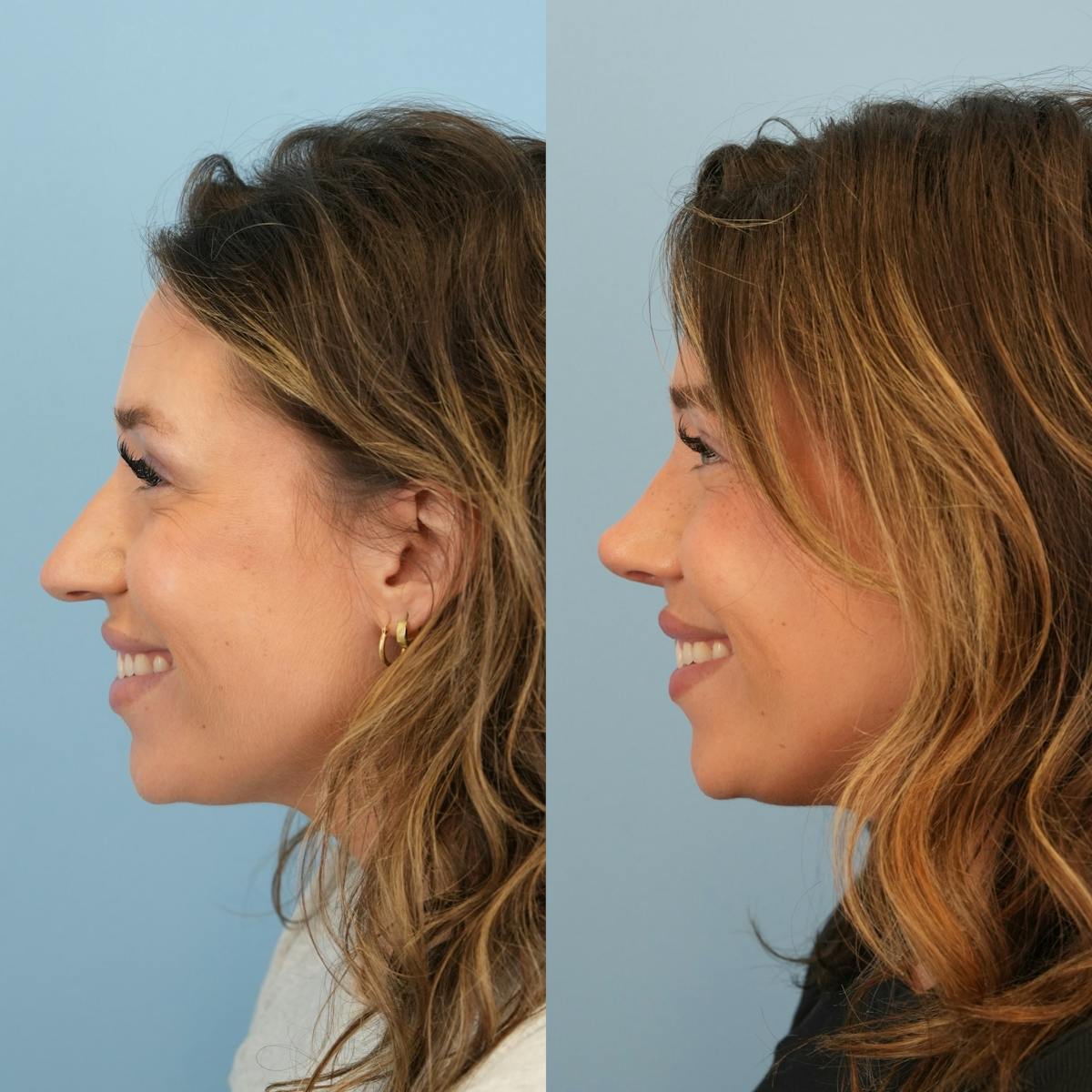 Rhinoplasty Before & After Gallery - Patient 425751 - Image 8
