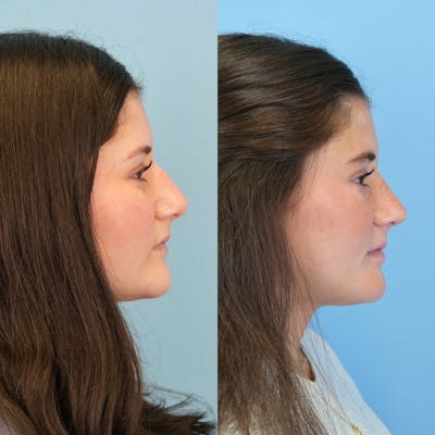 Rhinoplasty Before & After Gallery - Patient 536861 - Image 1