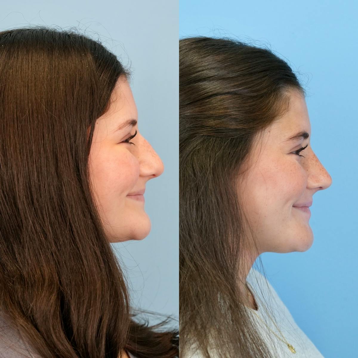 Rhinoplasty Before & After Gallery - Patient 536861 - Image 2