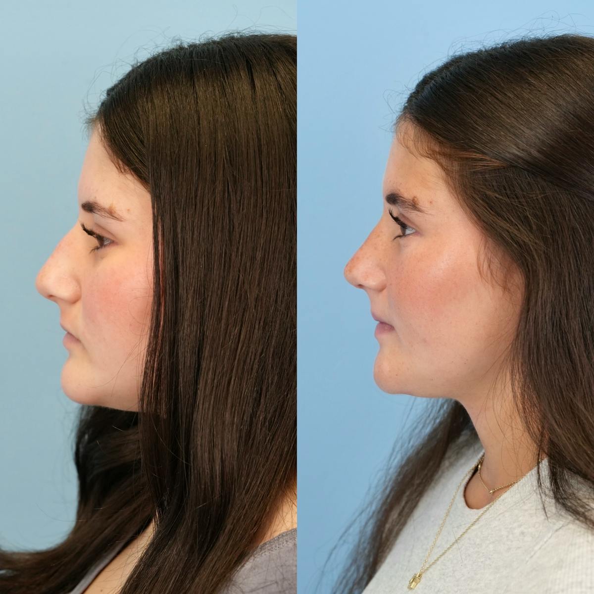 Rhinoplasty Before & After Gallery - Patient 536861 - Image 9