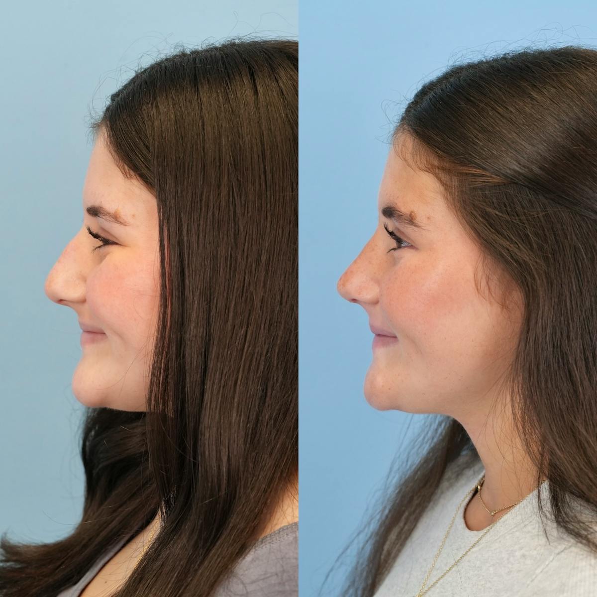 Rhinoplasty Before & After Gallery - Patient 536861 - Image 8