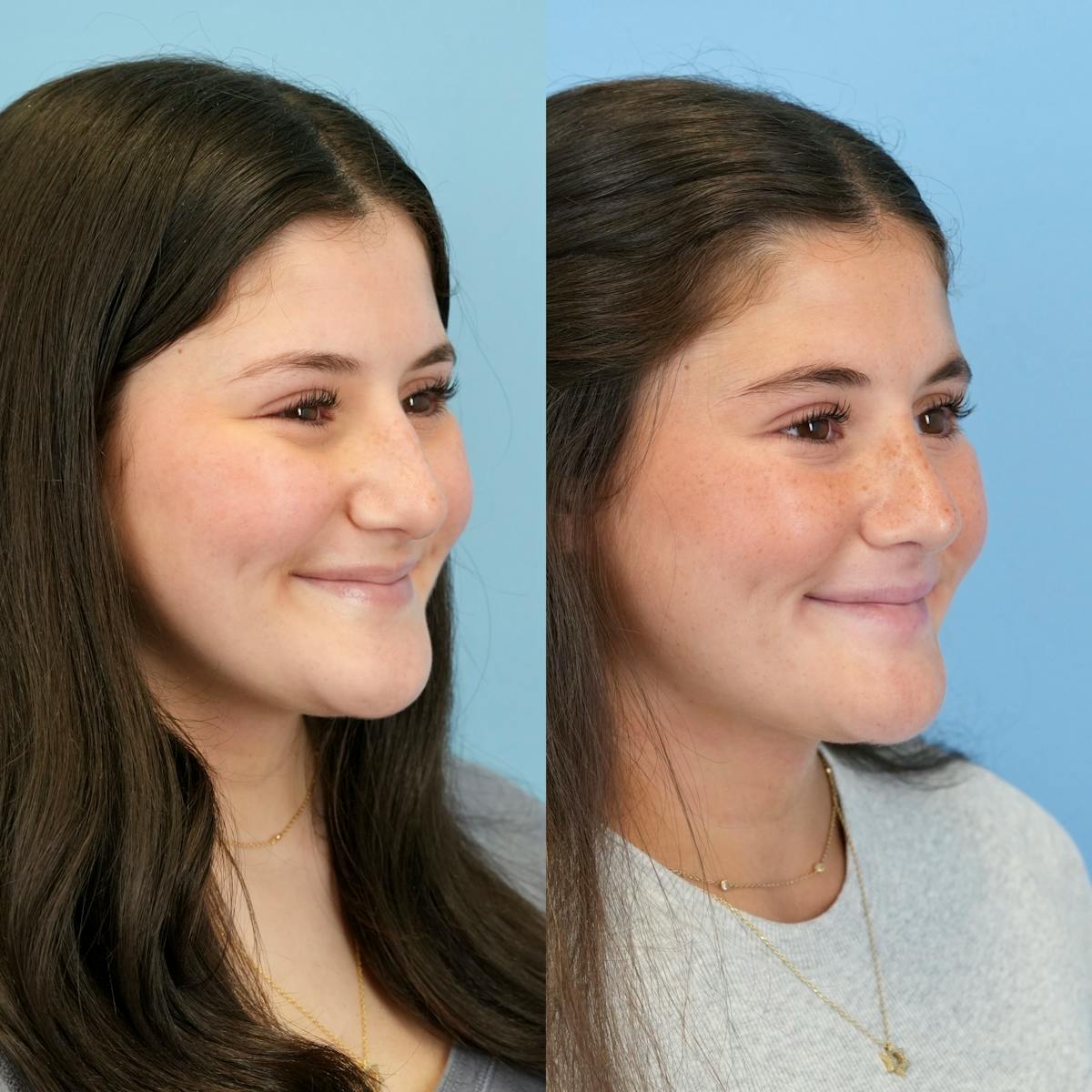Rhinoplasty Before & After Gallery - Patient 536861 - Image 4
