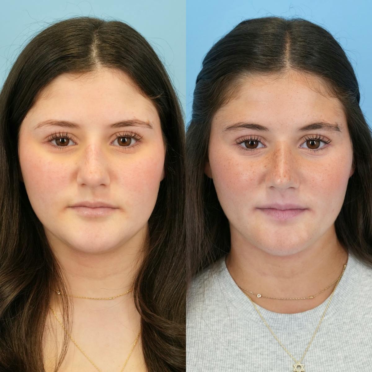 Rhinoplasty Before & After Gallery - Patient 536861 - Image 5