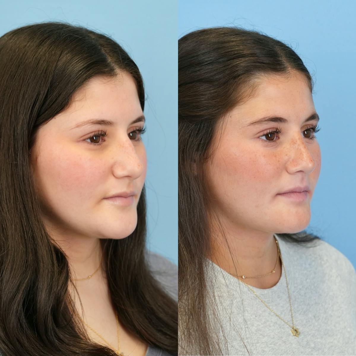Rhinoplasty Before & After Gallery - Patient 536861 - Image 3