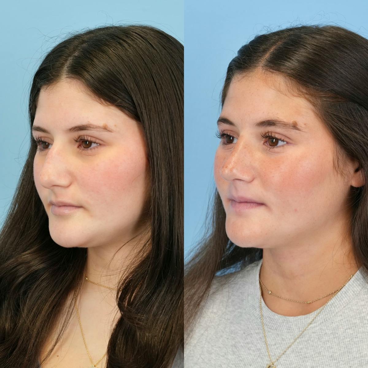 Rhinoplasty Before & After Gallery - Patient 536861 - Image 7