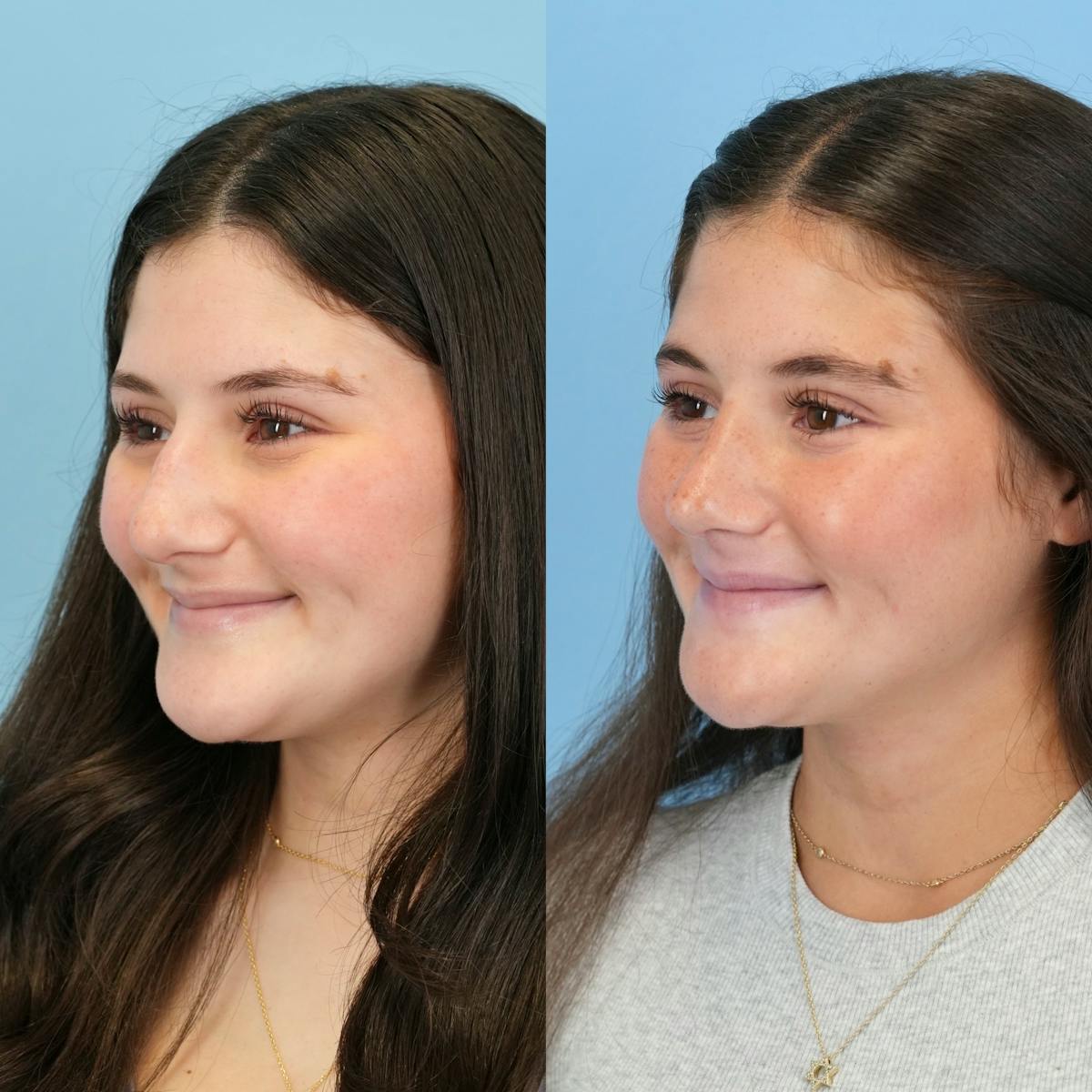 Rhinoplasty Before & After Gallery - Patient 536861 - Image 6