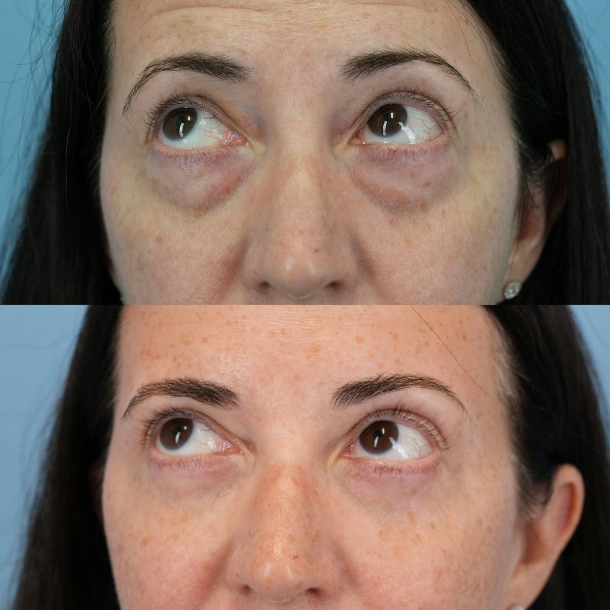 Blepharoplasty Before & After Gallery - Patient 320135 - Image 4