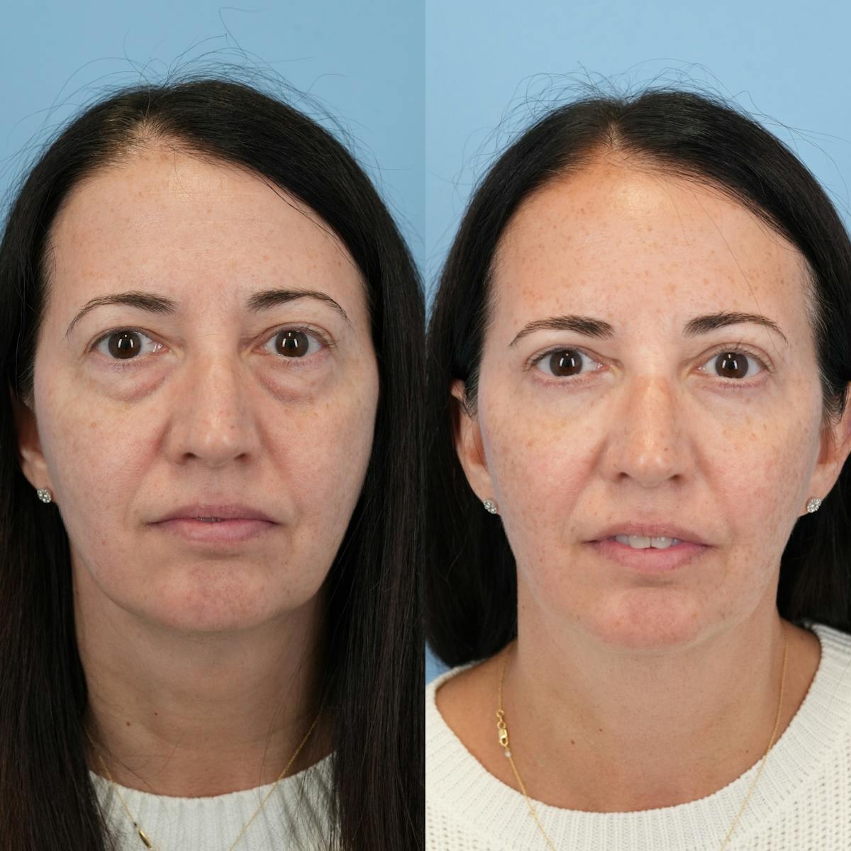 Blepharoplasty Before & After Gallery - Patient 320135 - Image 5