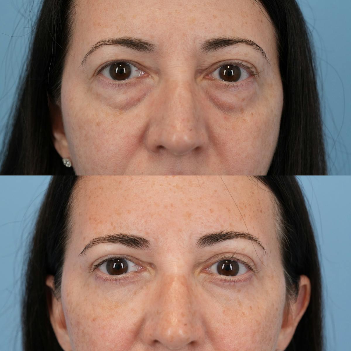Blepharoplasty Before & After Gallery - Patient 320135 - Image 1