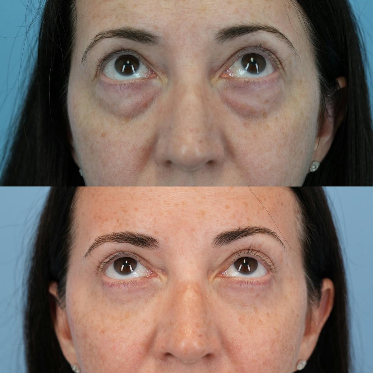 Blepharoplasty Before & After Gallery - Patient 320135 - Image 2