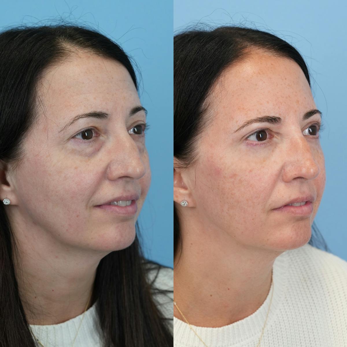 Blepharoplasty Before & After Gallery - Patient 320135 - Image 7