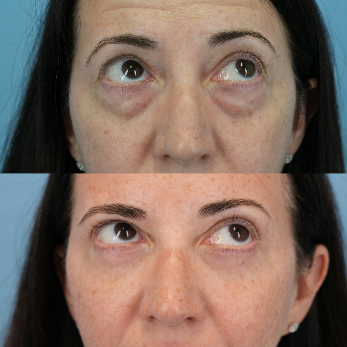 Blepharoplasty Before & After Gallery - Patient 320135 - Image 3