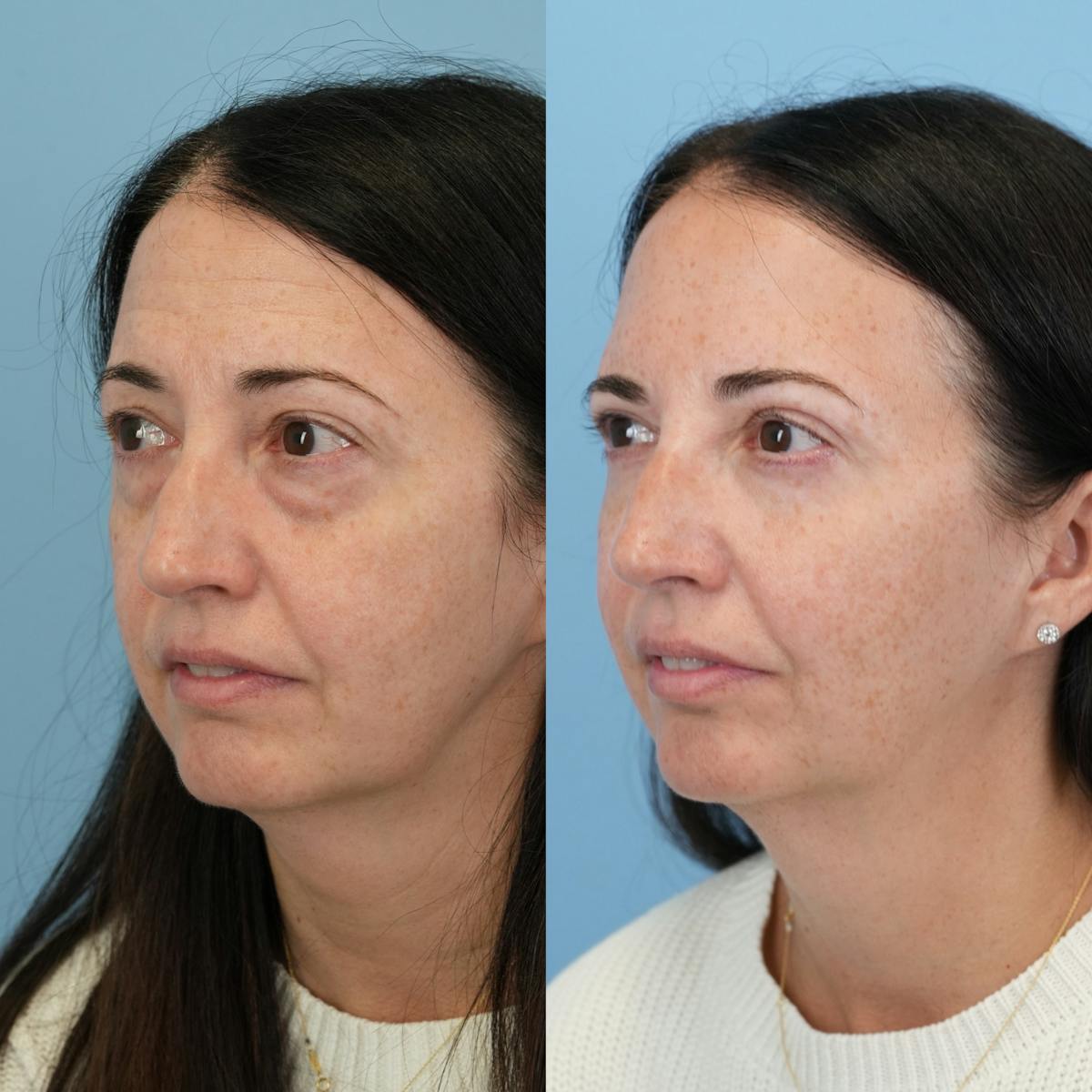 Blepharoplasty Before & After Gallery - Patient 320135 - Image 6