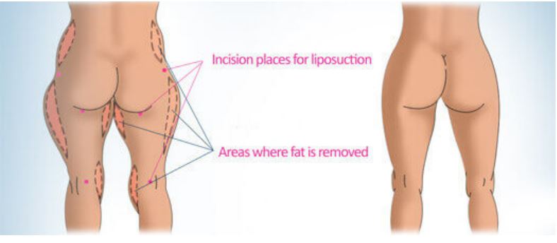 Liposuction Infographic