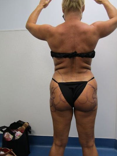 Brazilian Butt Lift Before & After Gallery - Patient 377025 - Image 1