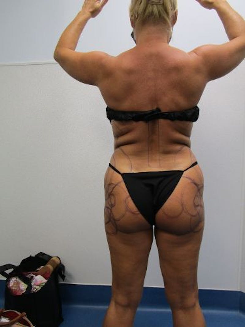 Brazilian Butt Lift Before & After Gallery - Patient 377025 - Image 1