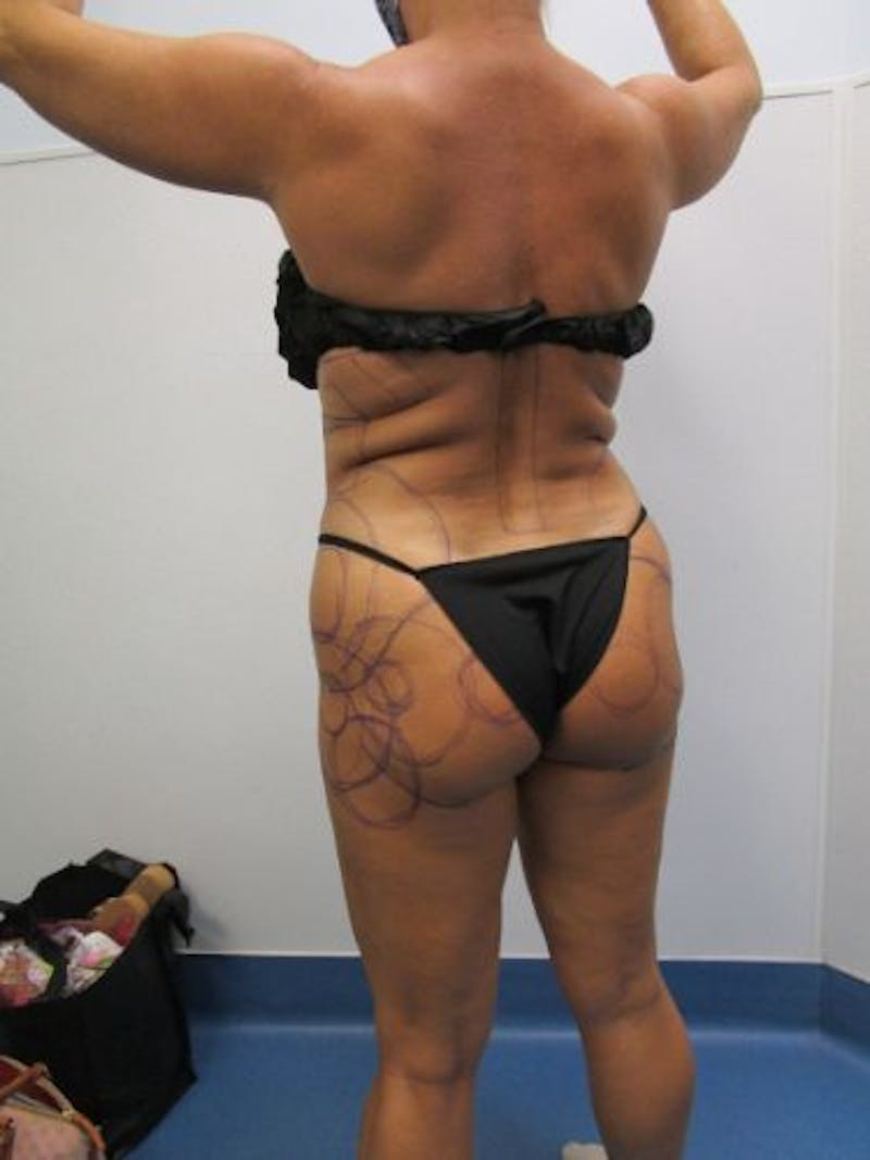 Brazilian Butt Lift Before & After Gallery - Patient 377025 - Image 3