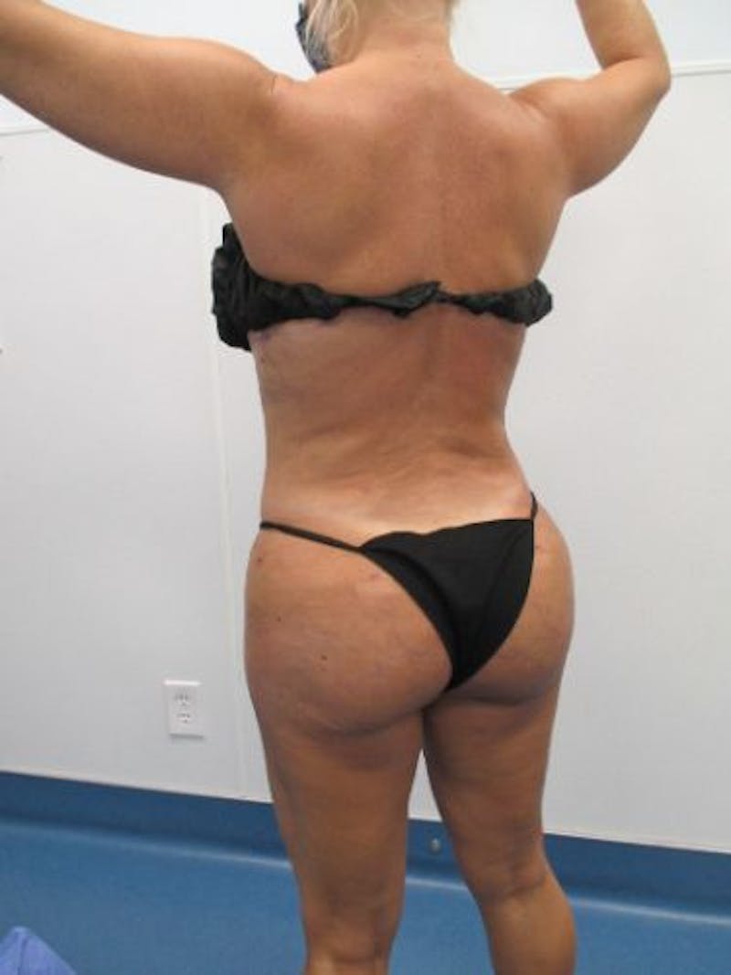 Brazilian Butt Lift Before & After Gallery - Patient 377025 - Image 4