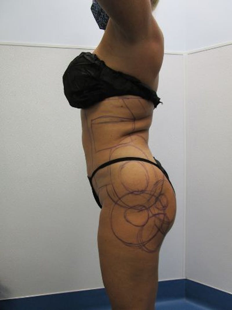 Brazilian Butt Lift Before & After Gallery - Patient 377025 - Image 5