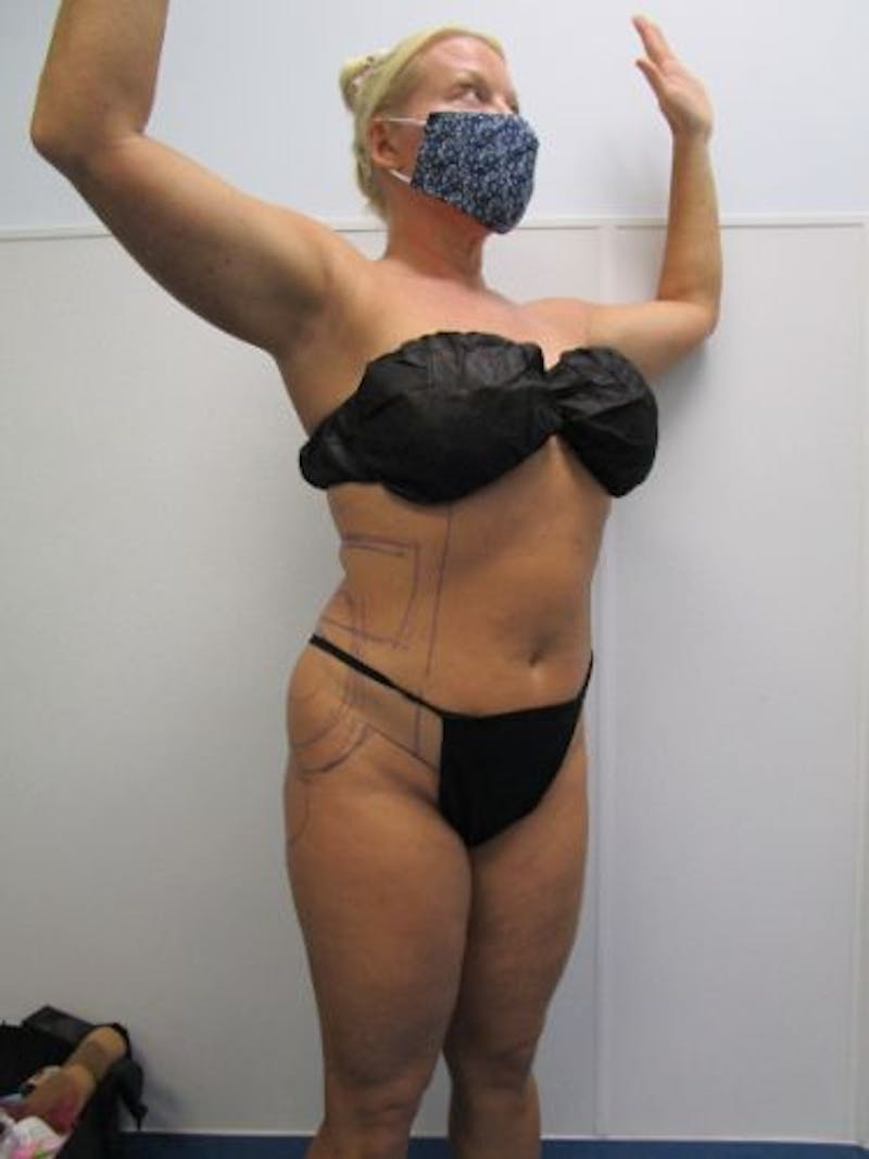 Brazilian Butt Lift Before & After Gallery - Patient 377025 - Image 7