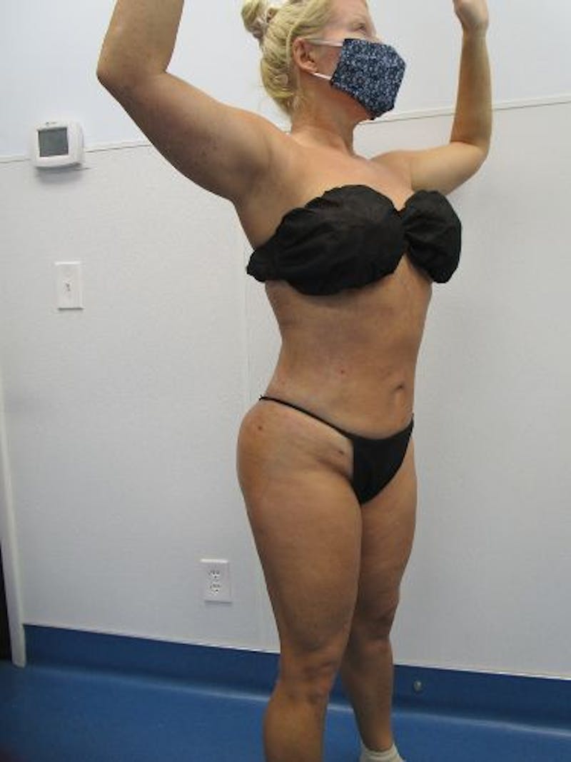 Brazilian Butt Lift Before & After Gallery - Patient 377025 - Image 8