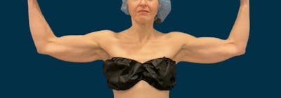 Brachioplasty (Arm Lifts) Before & After Gallery - Patient 116337 - Image 1