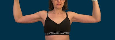 Brachioplasty (Arm Lifts) Before & After Gallery - Patient 116337 - Image 2