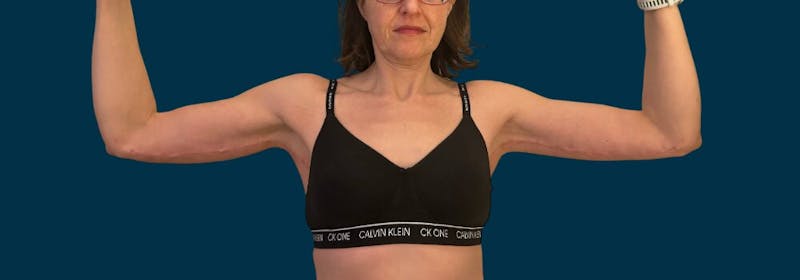 Brachioplasty (Arm Lifts) Before & After Gallery - Patient 116337 - Image 2
