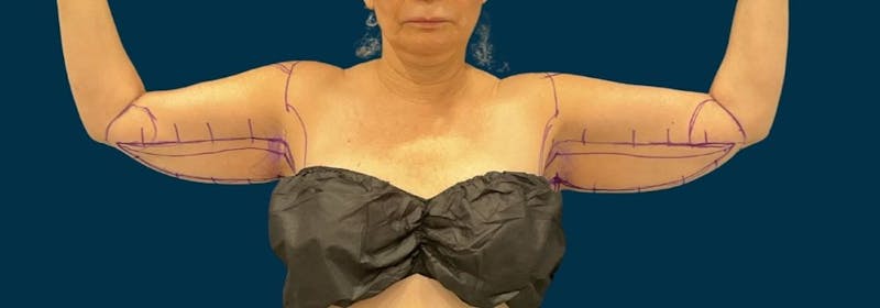 Brachioplasty (Arm Lifts) Before & After Gallery - Patient 407783 - Image 1
