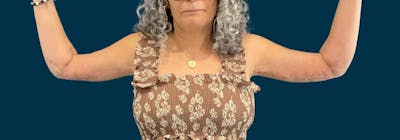 Brachioplasty (Arm Lifts) Before & After Gallery - Patient 407783 - Image 2