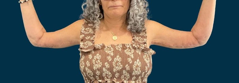 Brachioplasty (Arm Lifts) Before & After Gallery - Patient 407783 - Image 2