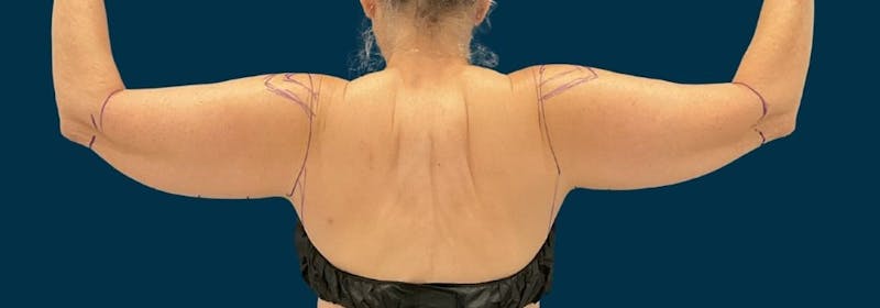 Brachioplasty (Arm Lifts) Before & After Gallery - Patient 407783 - Image 3