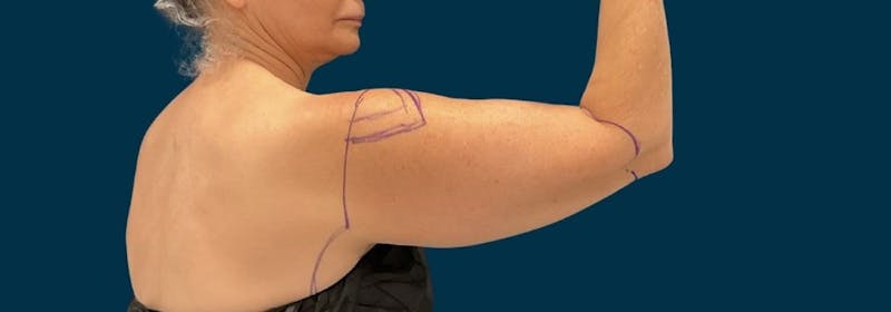 Brachioplasty (Arm Lifts) Before & After Gallery - Patient 407783 - Image 5