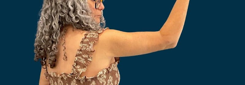 Brachioplasty (Arm Lifts) Before & After Gallery - Patient 407783 - Image 6