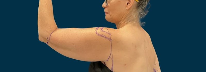 Brachioplasty (Arm Lifts) Before & After Gallery - Patient 407783 - Image 7