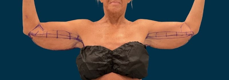 Brachioplasty (Arm Lifts) Before & After Gallery - Patient 346285 - Image 1