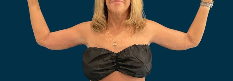 Brachioplasty (Arm Lifts) Before & After Gallery - Patient 346285 - Image 2