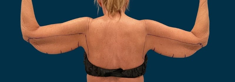 Brachioplasty (Arm Lifts) Before & After Gallery - Patient 346285 - Image 3