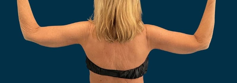 Brachioplasty (Arm Lifts) Before & After Gallery - Patient 346285 - Image 4
