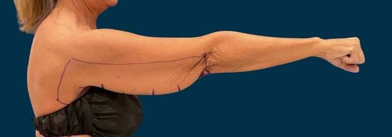 Brachioplasty (Arm Lifts) Before & After Gallery - Patient 346285 - Image 5