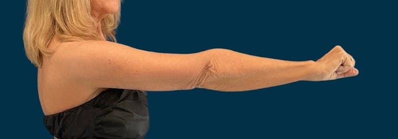 Brachioplasty (Arm Lifts) Before & After Gallery - Patient 346285 - Image 6