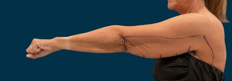 Brachioplasty (Arm Lifts) Before & After Gallery - Patient 346285 - Image 7