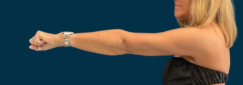Brachioplasty (Arm Lifts) Before & After Gallery - Patient 346285 - Image 8