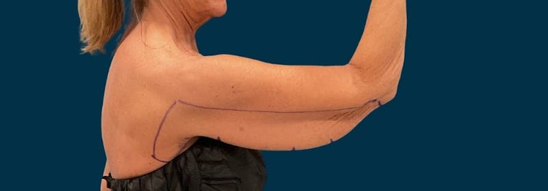 Brachioplasty (Arm Lifts) Before & After Gallery - Patient 346285 - Image 9